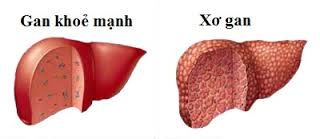 Thuốc Nam  trị xơ gan