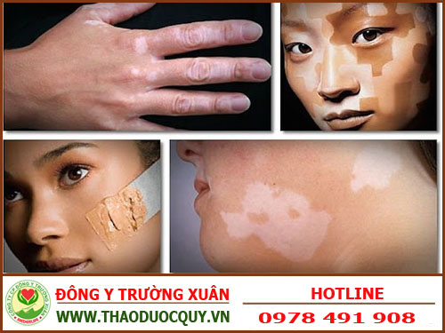 Những bài thuốc nam chữa bệnh bạch biến rất hiệu quả, nhiều người tin dùng