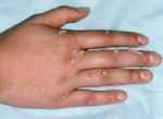 Mẹo trị mụn cơm, mụn cóc hiệu quả tại nhà